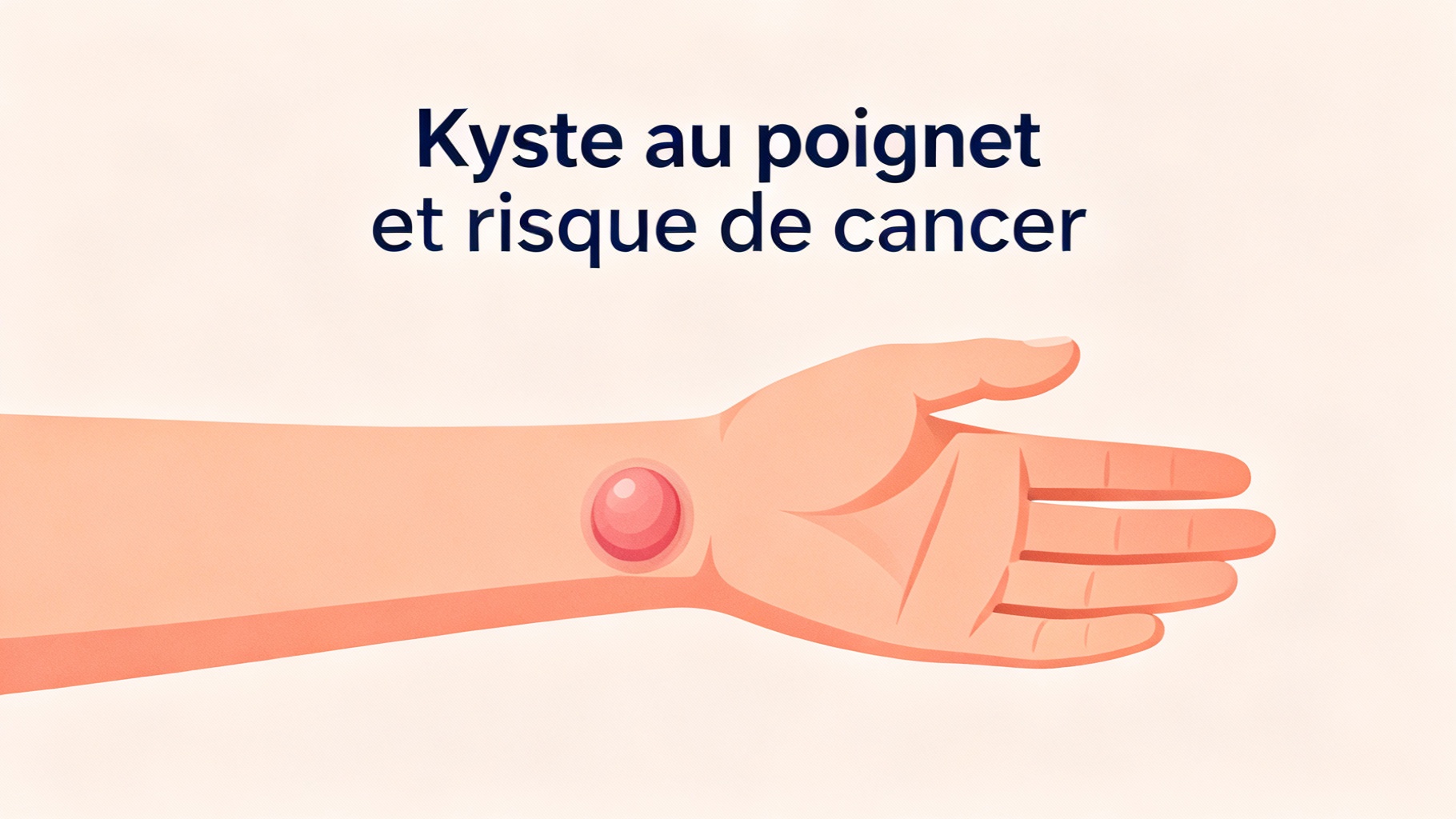Kyste au poignet et risque de cancer