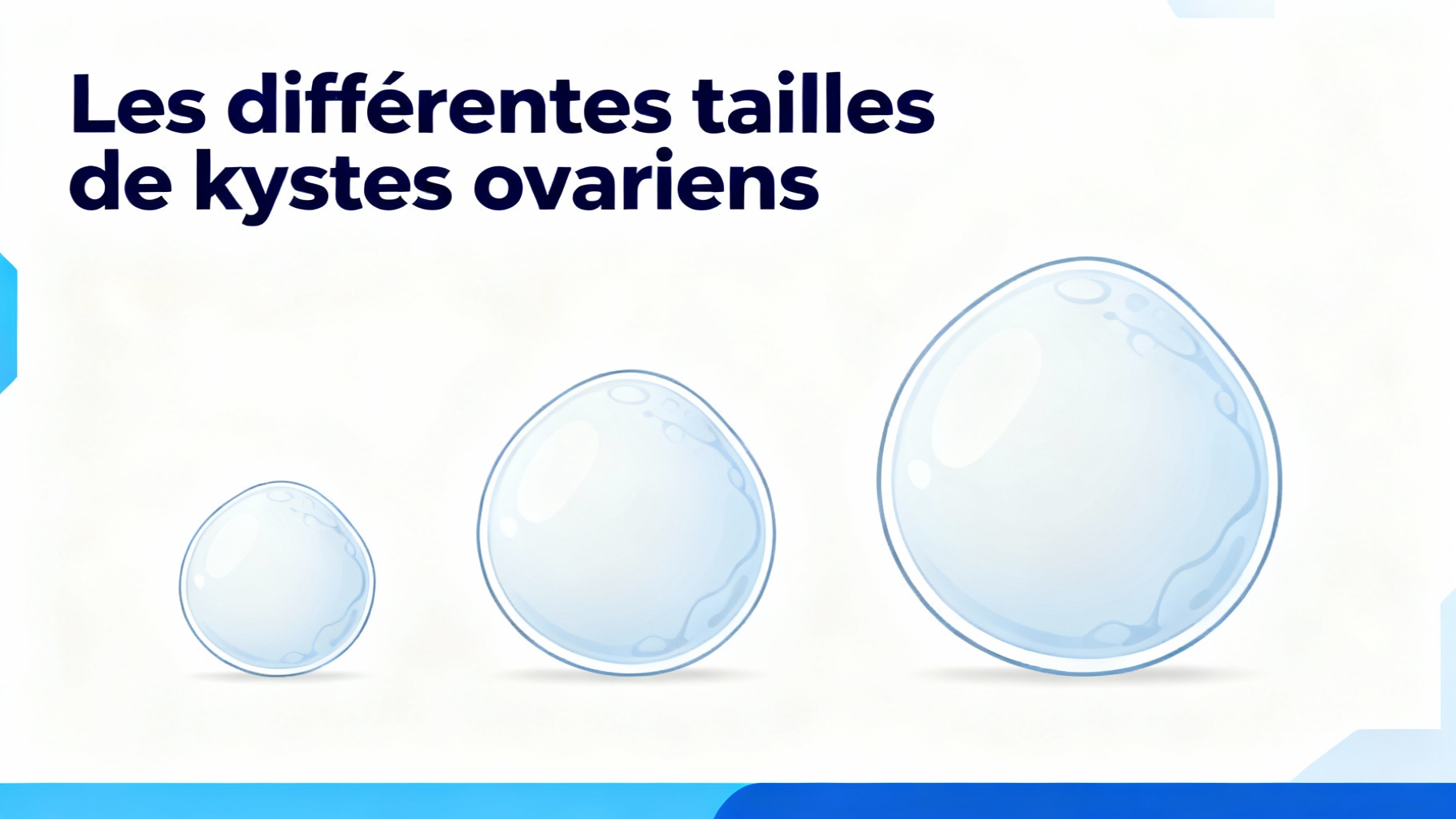 Les différentes tailles de kystes ovariens